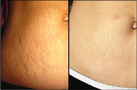 Skin Renov Antes e Depois
